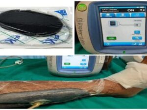 اسفنجة شفط جراحي 12*30 - Vac Negative Pressure Dressing